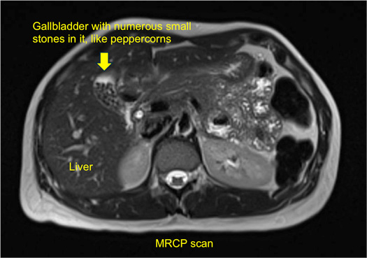MRCP scan